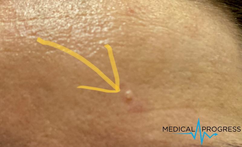 Jak powstają rogi skórne